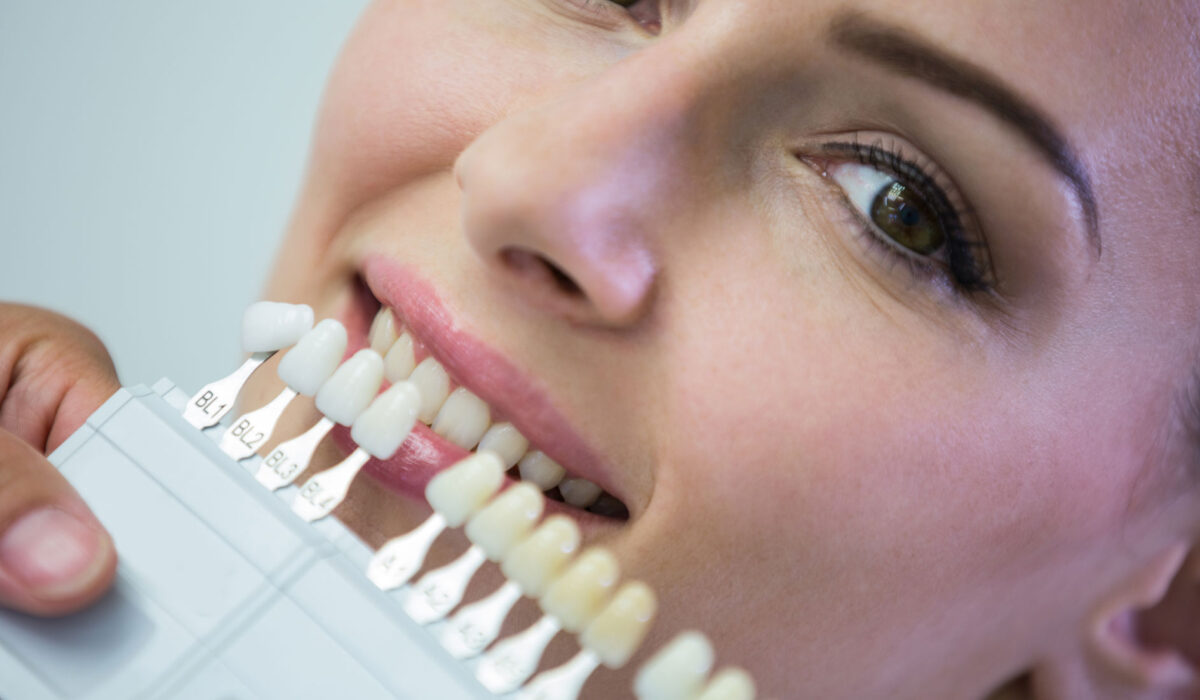 Sbiancamento e Faccette Dentali